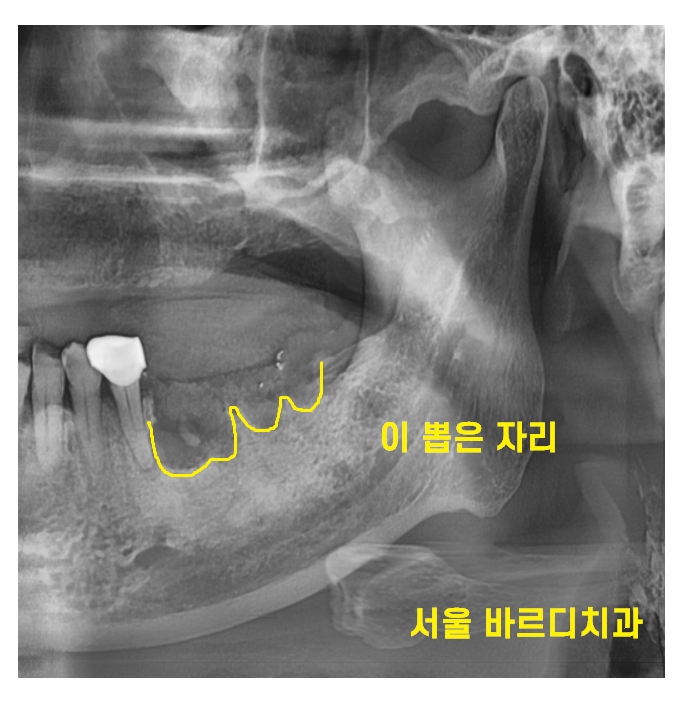 둔촌동 치과 80대 임플란트 가능한가요? 관련 이미지 7
