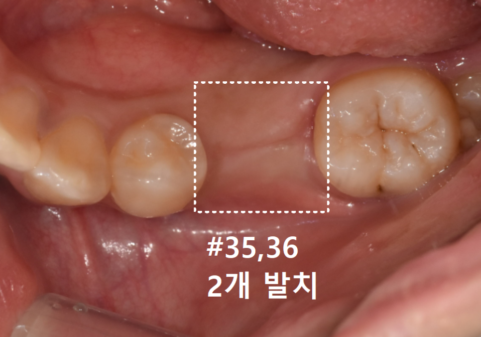 어금니 덧니 때문에 임플란트 해야 한다고요? 방치하면 안 되는 이유 관련 이미지 5