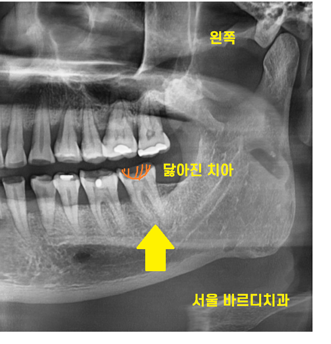 망월동 치과 신경치료 후 보철 꼭 씌워야 하나요?? 관련 이미지 3