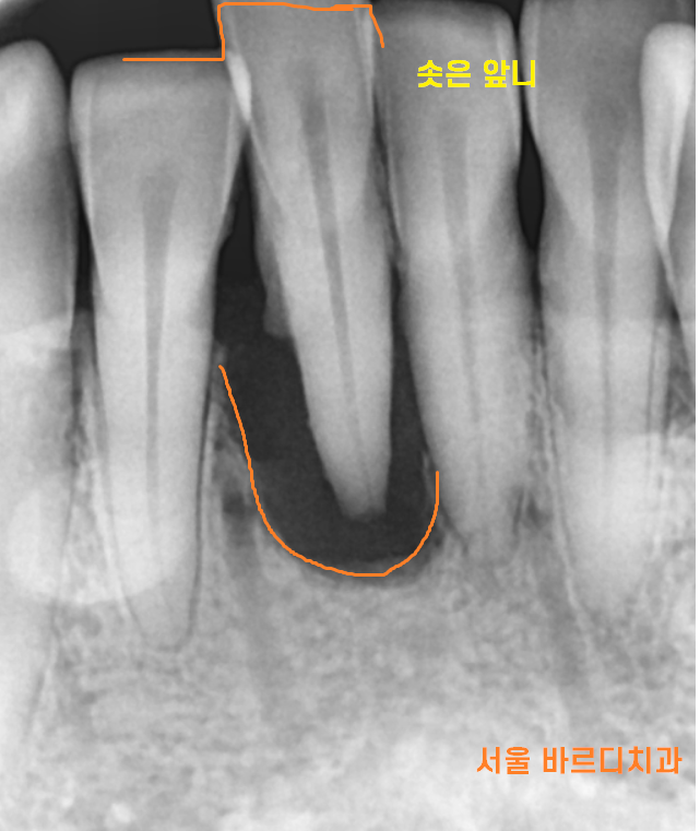 둔촌동 치과 아래 앞니 임플란트 뼈가 없을 때 일체형으로! 관련 이미지 3