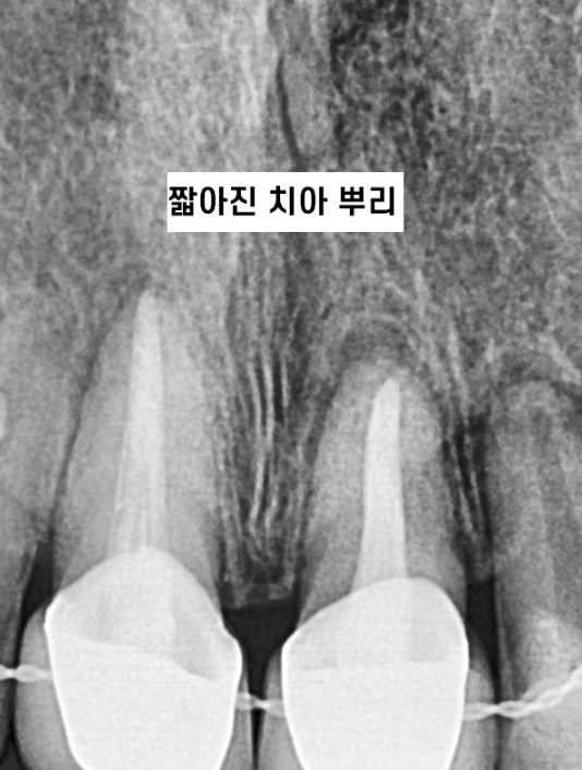 치아교정 치아 뿌리 짧아짐 치근 흡수 걱정이에요. 관련 이미지 2