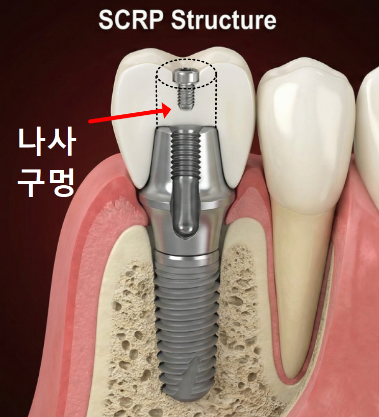 고덕 치과, 임플란트가 흔들려요. 뽑아야 할까 봐 고민이라면? 이렇게 해결합니다. 관련 이미지 8