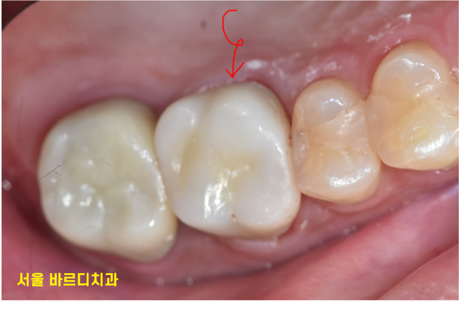 발치 대신 신경치료 뽑기 전 치료는 한번 해봐야하지않을까요? 관련 이미지 14