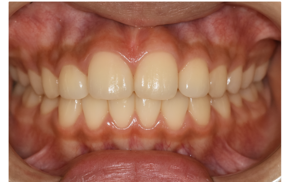 How to Correct a Canine Crowding Malocclusion: Extractions Are Necessary to Address Lip Protrusion image 9