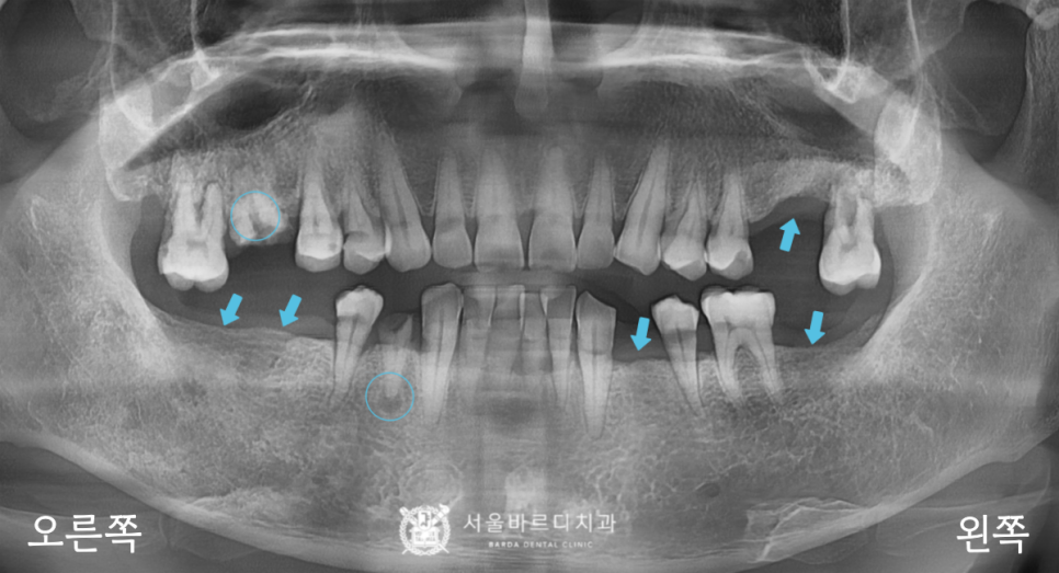 고덕동치과 서울바르디치과 무절개 네비게이션 임플란트 치료증례 #1 관련 이미지 1