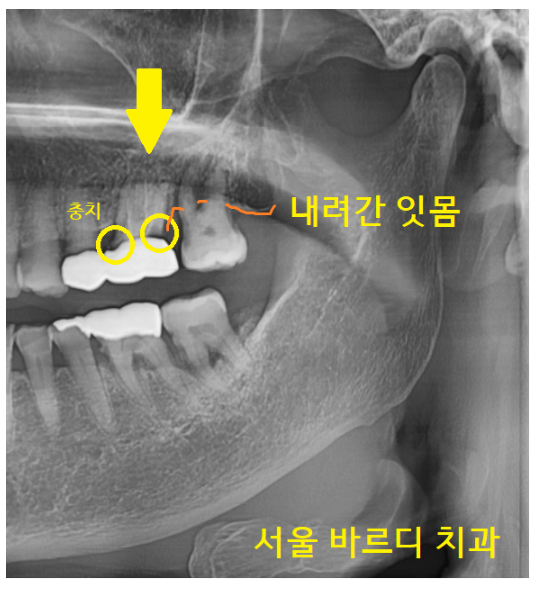 치아 크라운 빠짐 살릴 수 없을 때 강일역 임플란트 관련 이미지 3