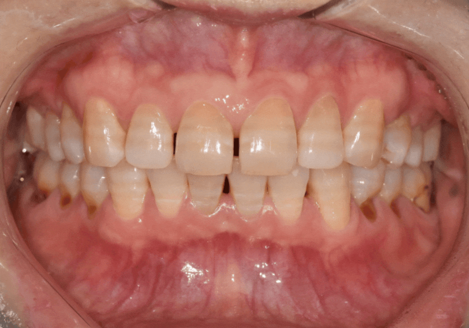 앞니 변색, 치아미백효과 없는 이유 솔직하게 말씀드립니다. 관련 이미지 9
