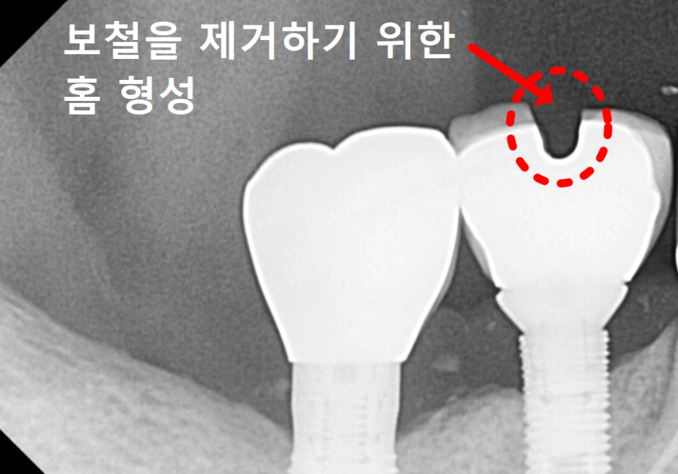 고덕 치과, 임플란트가 흔들려요. 뽑아야 할까 봐 고민이라면? 이렇게 해결합니다. 관련 이미지 9