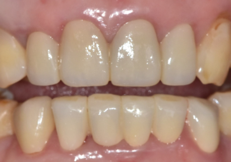 Gangdong-gu Dental Impressions: Are You Still Biting Down for 5 Minutes? We’ll Make It Comfortable with an Intraoral Scanner! image 14