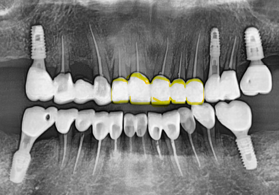 앞니 음식물 끼임, 왜 젊을 때보다 더 자주 발생하는 걸까요? 까맣게 변한 앞니 치료 사례 관련 이미지 8