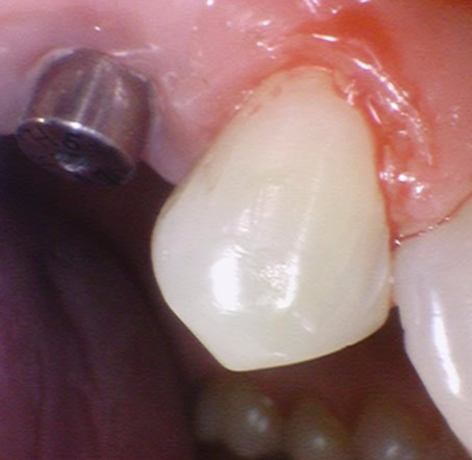 씌운 치아 부러짐 뿌리만 남은 경우 임플란트로 수복하기 관련 이미지 7