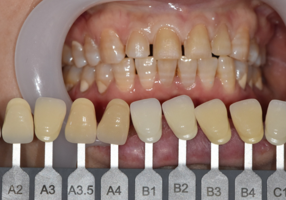 50대 라미네이트, 앞니 벌어짐과 변색 고민 이렇게 해결했습니다. 관련 이미지 6
