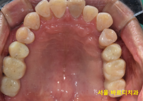 길동 치과 임플란트 뼈이식 후 흡연 상관 있을까? 관련 이미지 11