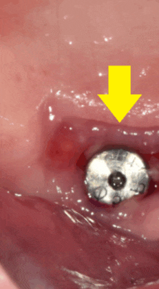 임플란트 뚜껑 빠짐 시공이 잘못된거 아냐? 생각이 들으셨다면 관련 이미지 1