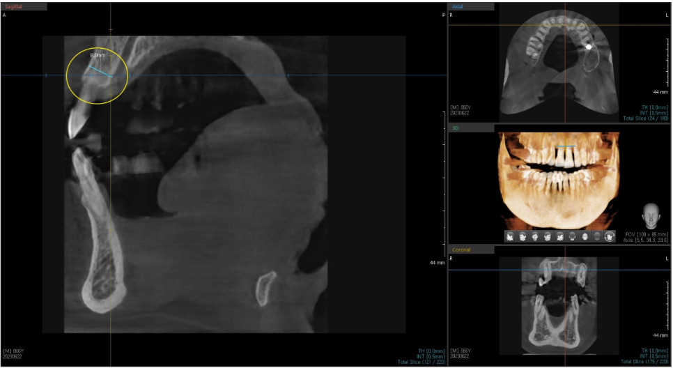 상일동치과 서울바르디치과 무절개 네비게이션 임플란트 치료증례 #3 관련 이미지 4