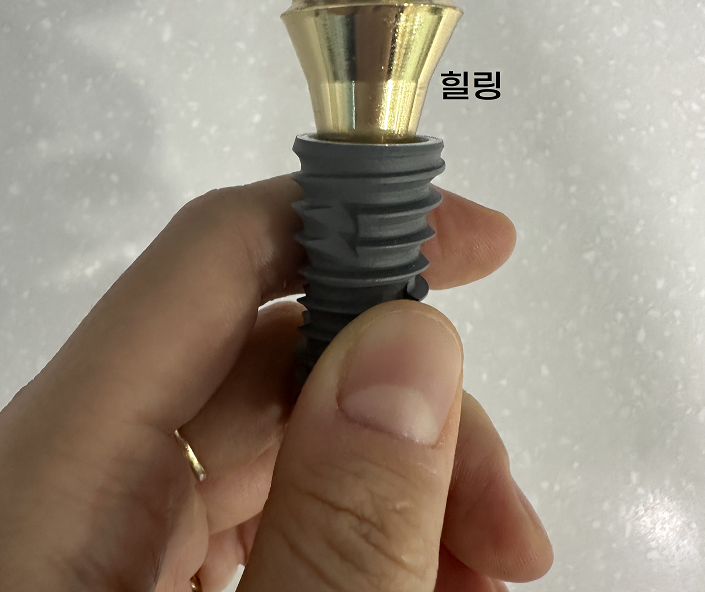 임플란트 뚜껑 빠짐 시공이 잘못된거 아냐? 생각이 들으셨다면 관련 이미지 6