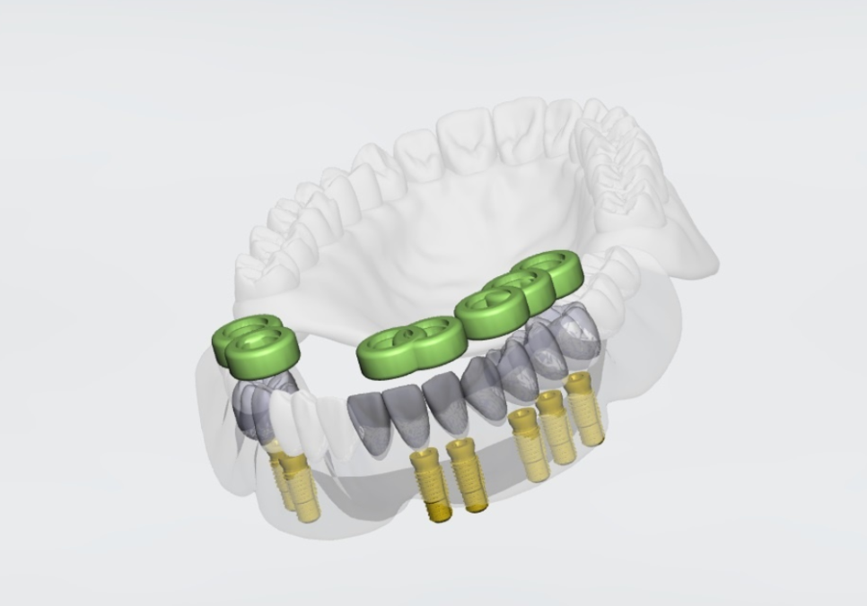 천호 디지털 가이드 임플란트, 일반 임플란트와 무슨 차이가 있나요? 관련 이미지 5