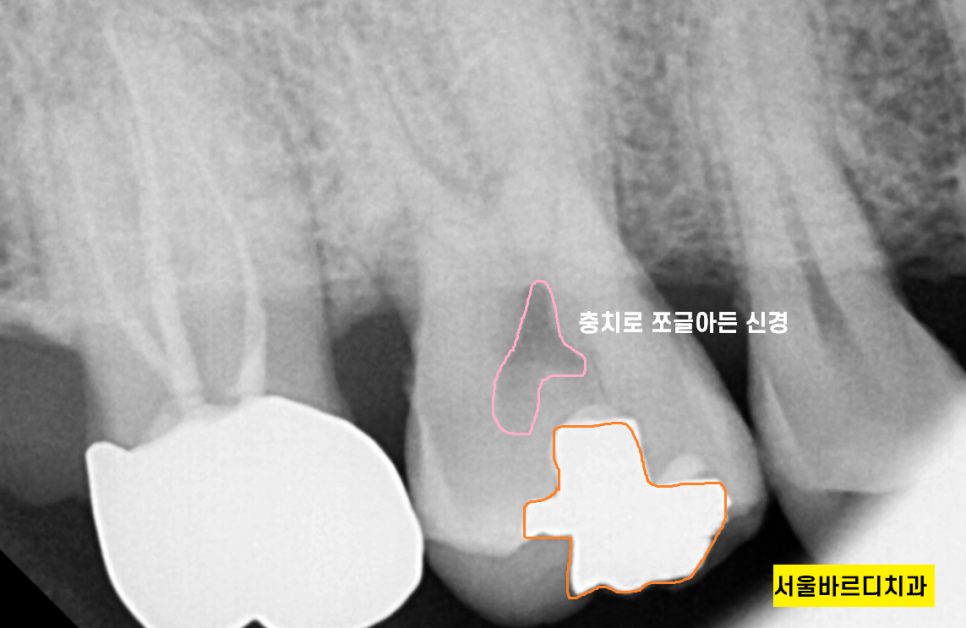 풍산동 치과 골드 인레이 치료했던 치아가 또 충치가 생김. 관련 이미지 4