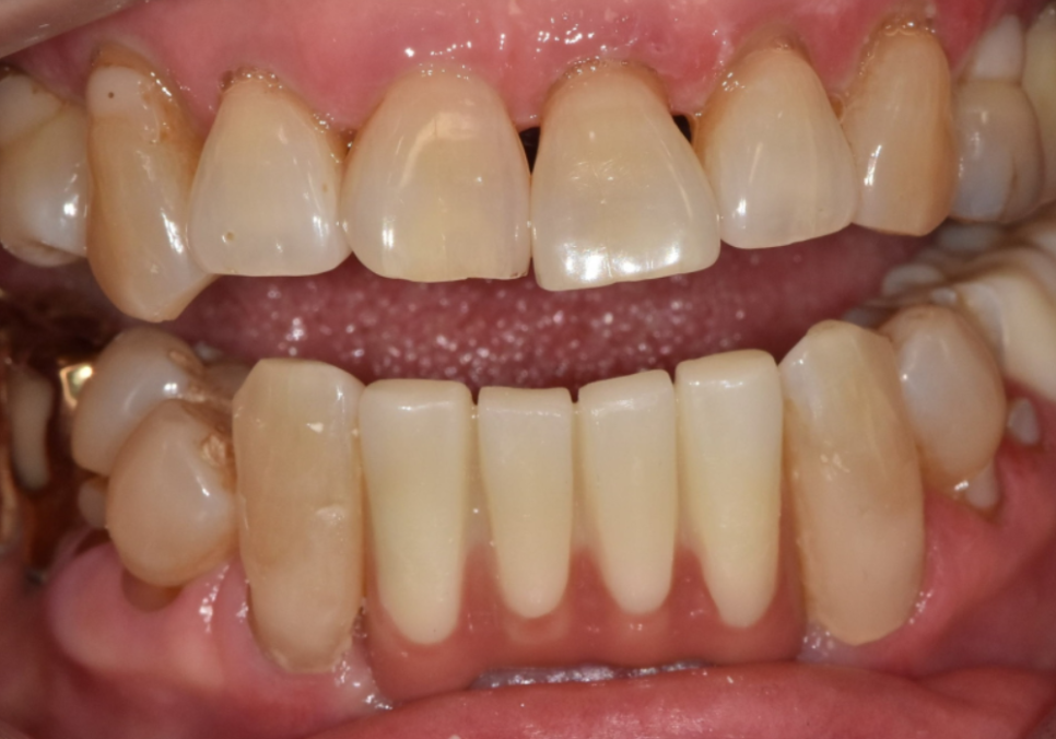 흔들리는 치아 묶어두는 잠간고정술, 오히려 잇몸뼈를 녹일 수도 있다고요? 관련 이미지 13