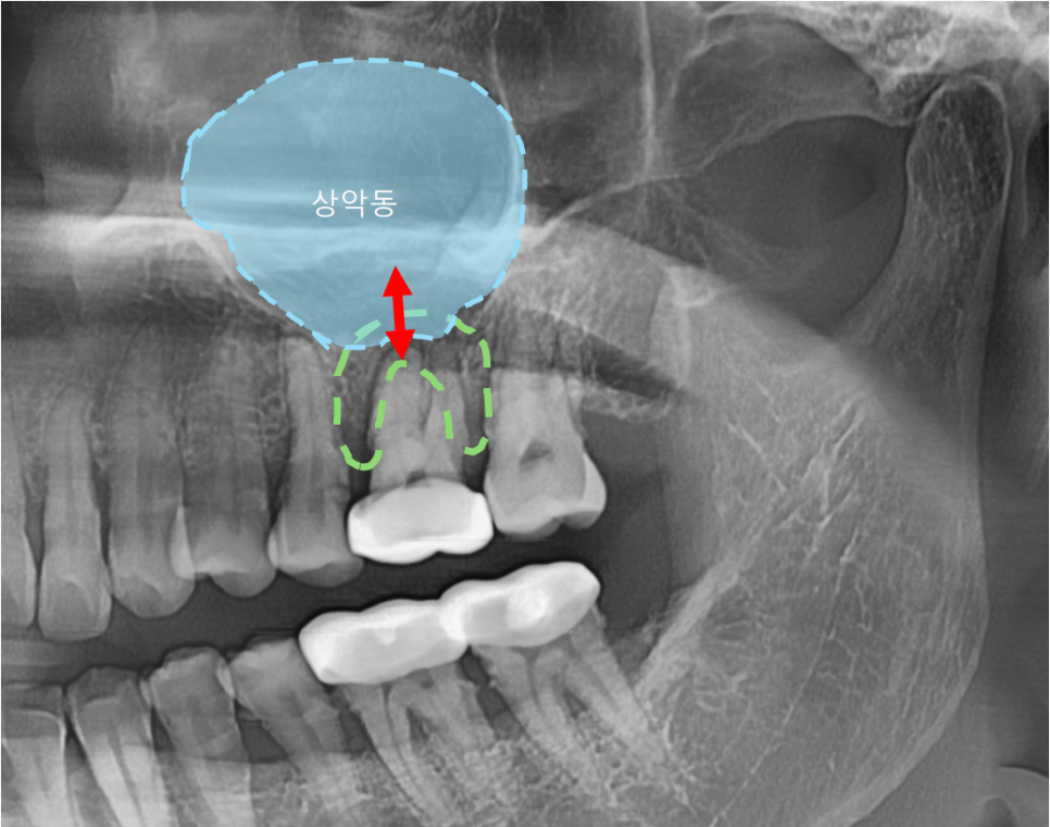 고덕동치과 서울바르디치과 무절개 네비게이션 임플란트 치료증례 #2 관련 이미지 7