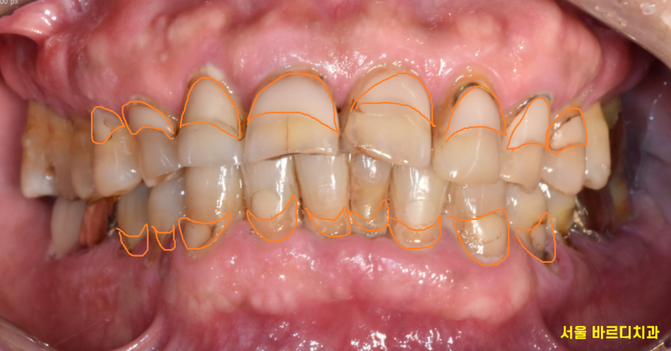 잇몸 주저앉음 발치하게 되는 제일 큰 원인이기에 잇몸치료 과정 공개 관련 이미지 5