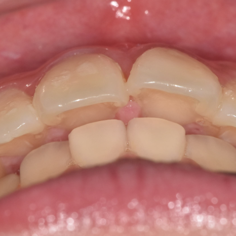 Can Protruding Mouth Be Corrected with Orthodontics Alone, Without Surgery? Sangil-dong Orthodontic Clinic image 5