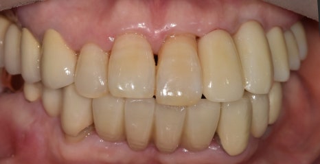 A Pimple Outside the Gums: Bridge Retreatment Implant Case Due to Bone Loss image 7