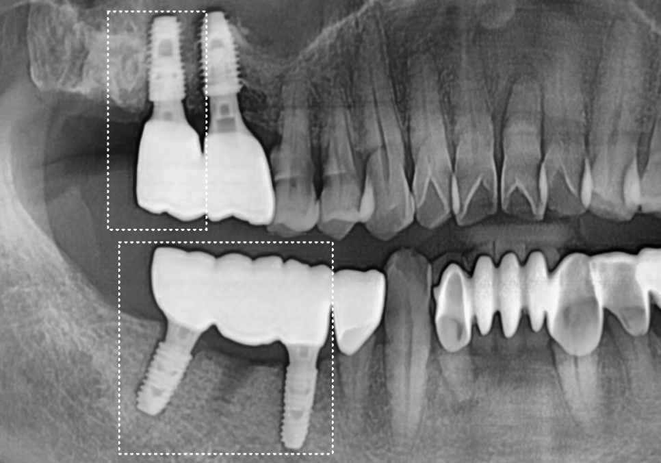 고덕동 어금니 브릿지 교체, 관련 이미지 13
