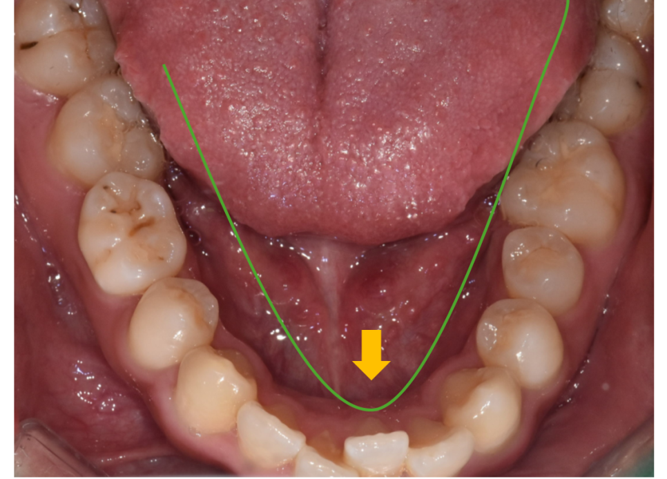 Adult Chin Correction: It Can Go Beyond Appearance Issues and Even Disturb You During Sleep image 5