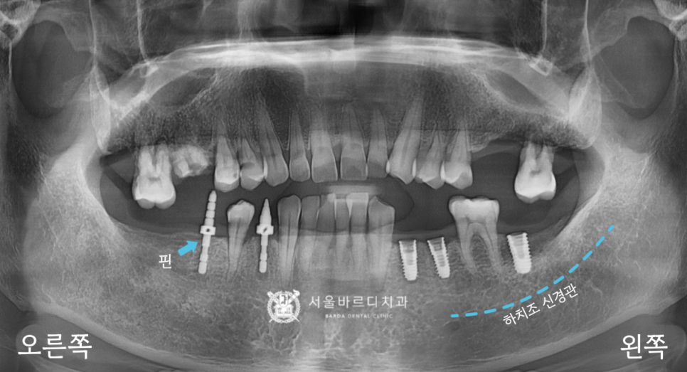 고덕동치과 서울바르디치과 무절개 네비게이션 임플란트 치료증례 #1 관련 이미지 9