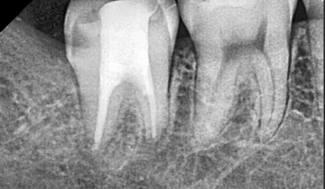 상일동 사랑니 매복 방치하다 옆 치아까지 망가진 실제 사례 관련 이미지 14