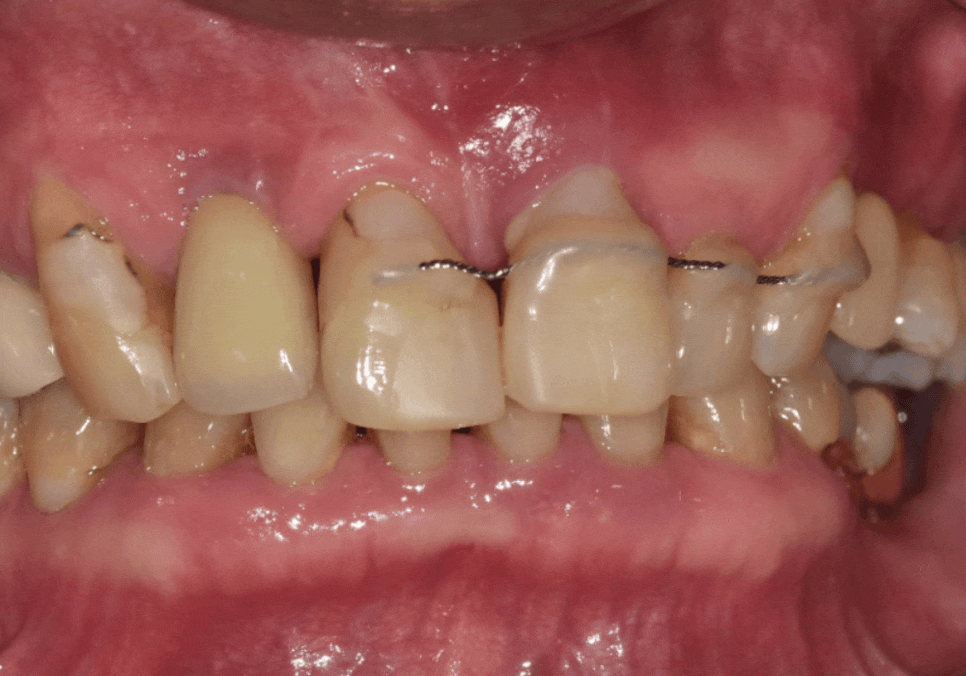 앞니 흔들림, 임플란트 치아보험 감액 기간 넘기려다 더 큰 손해 봅니다. 관련 이미지 13