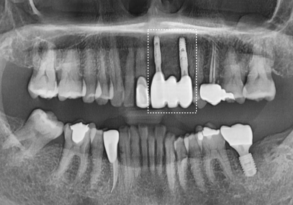 오래된 앞니 크라운 냄새, 관련 이미지 14