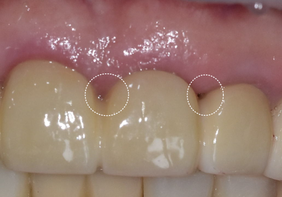 앞니 음식물 끼임, 왜 젊을 때보다 더 자주 발생하는 걸까요? 까맣게 변한 앞니 치료 사례 관련 이미지 9