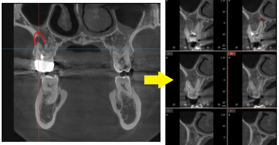 발치 대신 신경치료 뽑기 전 치료는 한번 해봐야하지않을까요? 관련 이미지 12