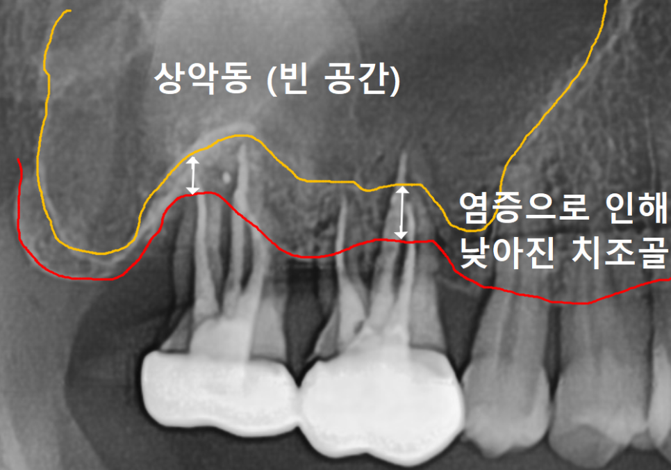 앞니 뿌리 염증, 자연치유될까? 아프지 않아도 치료가 필요한 이유 관련 이미지 2