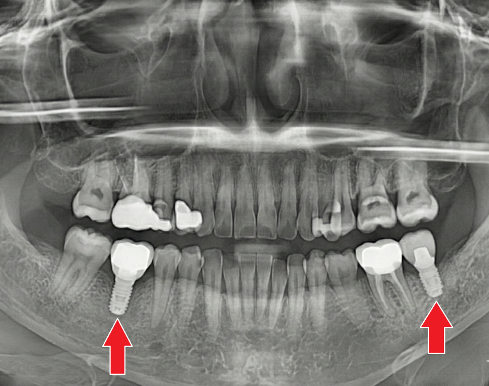 고덕역 임플란트, 뼈이식 꼭 해야 할까? 필수 상황 vs 제외 상황 총정리 관련 이미지 14