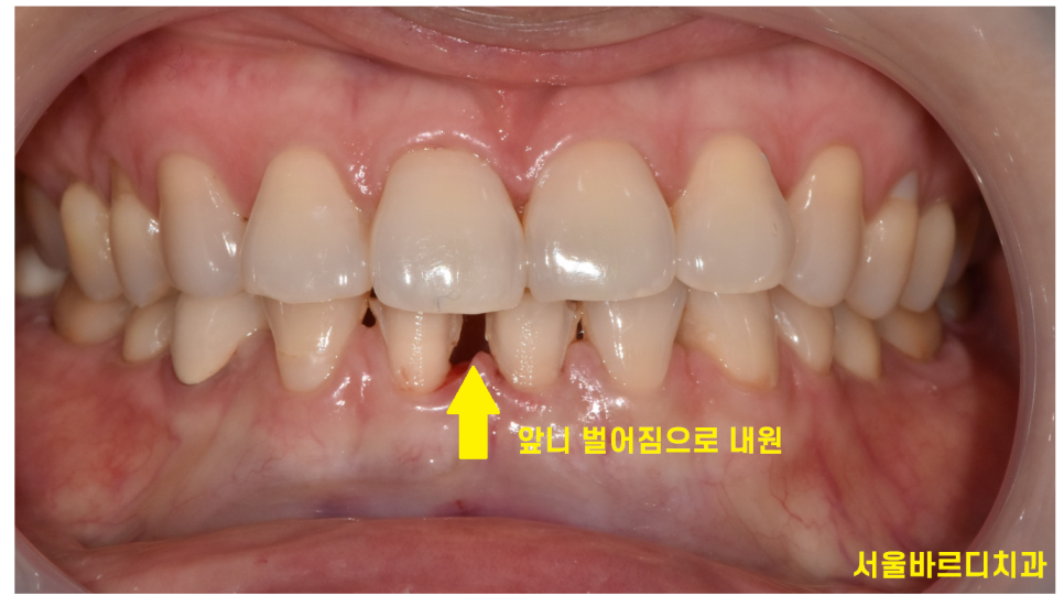 고덕동 치과에서 시행한 라미네이트와 치아 미백 과정 및 순서 관련 이미지 2