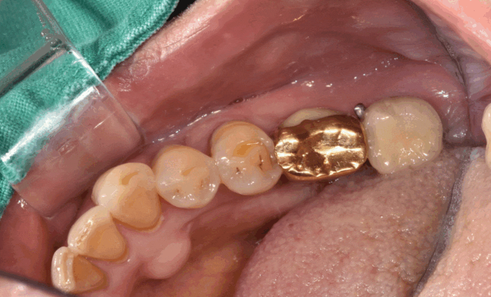 암사동 치과 치아 뿌리 균열 금 갔을 때 임플란트 치료로 행복해지세요. 관련 이미지 1