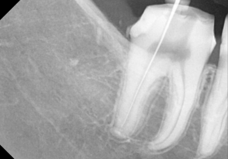 고덕동 사랑니 매복 발치, 안 아픈데 꼭 빼야 하나요? 관련 이미지 14
