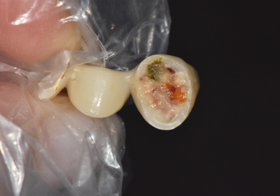 오래된 앞니 크라운 냄새, 관련 이미지 6