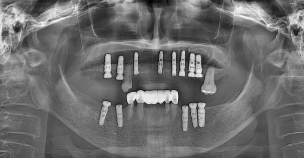 고덕역 치과 위아래 전체 임플란트 디지털을 사용하는 이유? 관련 이미지 7