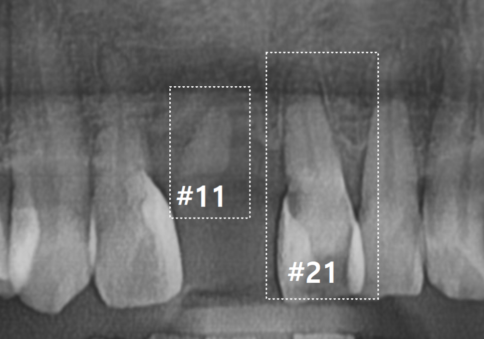 대문니 빠짐, 앞니 빠졌을 때 브릿지와 임플란트 중 나에게 맞는 선택은? 관련 이미지 4