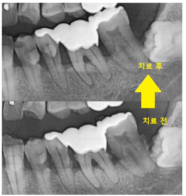 상일동역 스케일링 치과 잇몸치료 받아야하는 이유 필독! 관련 이미지 6