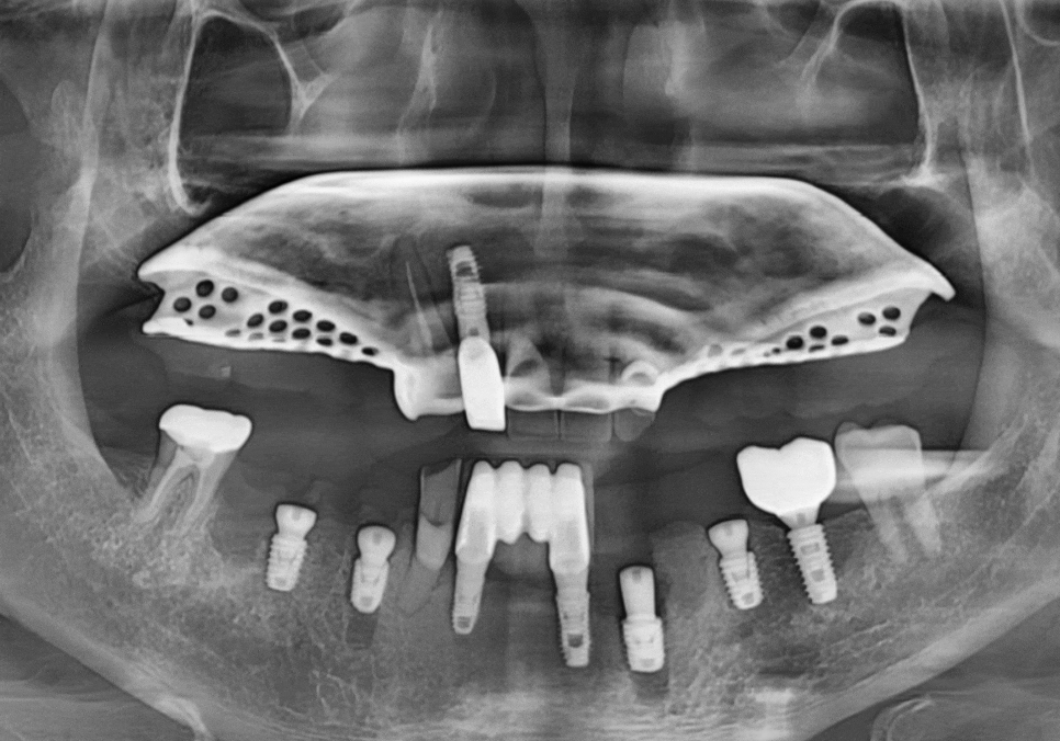 Cheonho Dental Clinic, Are You Over 65? We’re Revealing How to Reduce Denture and Implant Costs. image 10
