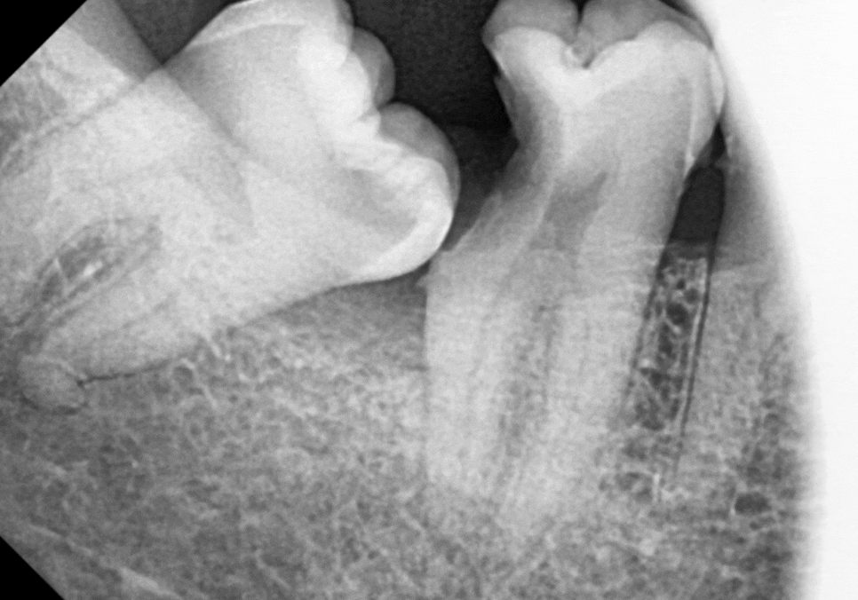 수평 매복 사랑니, 옆으로 누운 사랑니 때문에 멀쩡한 어금니까지 뽑은 사연 관련 이미지 8