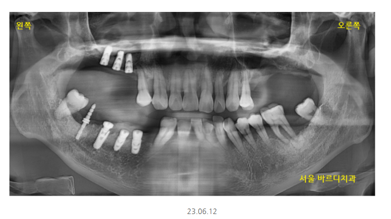 길동 치과 임플란트 뼈이식 흡연 관련 있을까? 관련 이미지 7