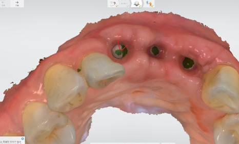 상일동역 치과 윗니 앞니 흔들림 임플란트로 심미까지 잡았습니다. 관련 이미지 12