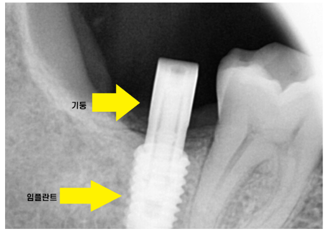 하남시청치과 내비게이션 임플란트 왜 좋다는거죠? 관련 이미지 8