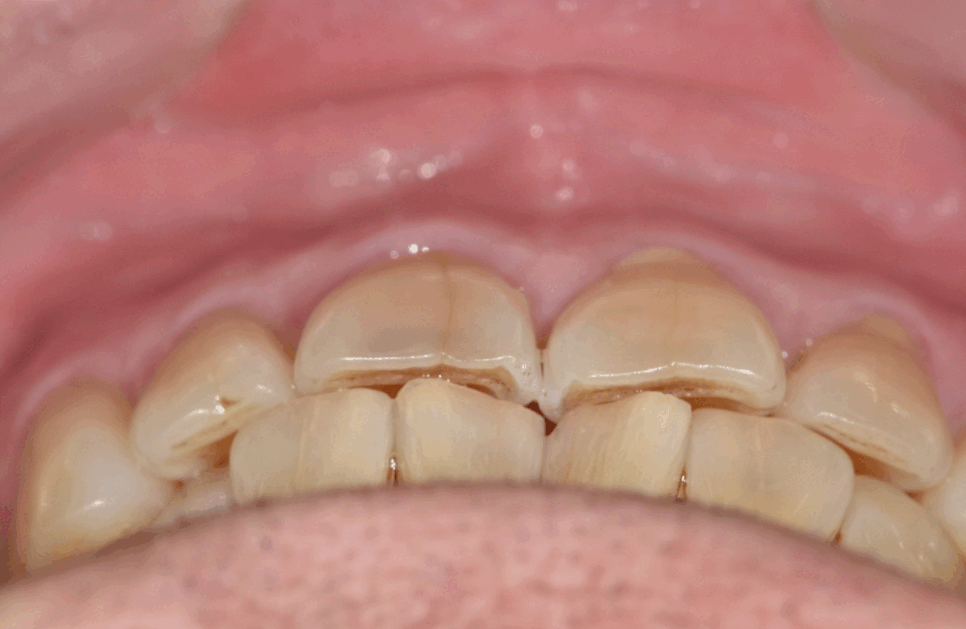 앞니 금 갔을 때, 방치하면 안 되는 진짜 이유 <파절 치료 사례> 관련 이미지 5